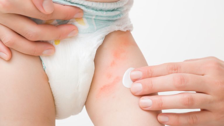 Young adult mother hand applying white medical ointment on toddler leg. Red rash on skin from diaper. Care about baby body. Closeup. Front view. Isolated on light gray background.