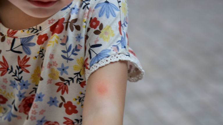 Mosquito or insect bite on child's arm